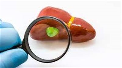 هل مرض حصيات المرارة قد يكون مؤشرا قويا على سرطان قاتل؟.. دراسة تُجيب