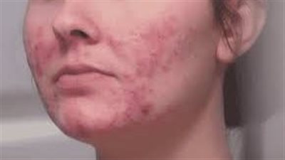 كيف تساعد في منع ظهور حب الشباب وجعل البشرة أكثر نقاء؟