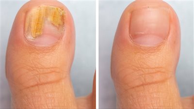  علاجات منزلية لمرض فطريات القدم