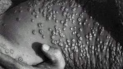 الصحة العالمية تصدر تحذيرا خطيرا مع اكتشاف أربع حالات أخرى من جدري القرود بالمملكة المتحدة