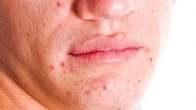 كيفية منع ظهور حب الشباب وجعل البشرة أكثر نقاء