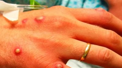 وزارة الصحة في ولاية ماساتشوستس الأمريكية تعلن اكتشاف الحالة الأولى لمرض 