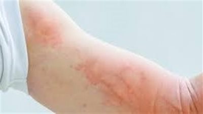  أهم العوامل التي تؤدي إلى الإصابة بعدم تحمل الهيستامين