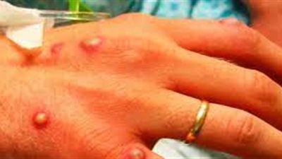 سي إن إن: 99% من المصابين بجدري القردة في الولايات المتحدة الأمريكية من المثليين