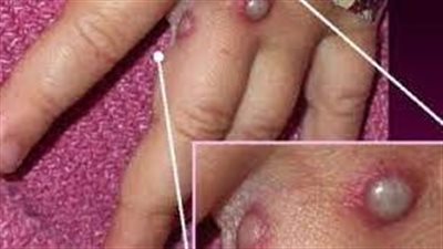 كل ما تريد معرفته حول مرض جدري القرود 