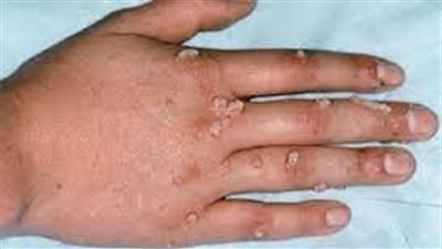 منظمة الصحة العالمية توضح أنها تتوقع رصد المزيد من حالات الإصابة بجدري القرود