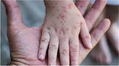 سلطات ولاية نيويورك تؤكد تسجيل إصابة بـ جدري القرود