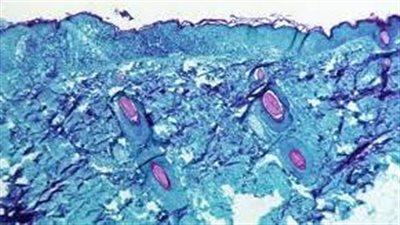 وزارة الصحة الأردنية تضع خطة لتعريف الحالة المرضية لجدري القردة