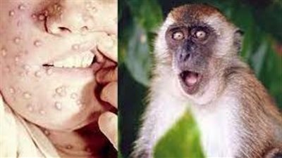  الصحة العالمية تتوقع رصد المزيد من حالات الإصابة بجدري القرود