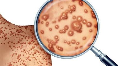 معلومات جديدة حول مرض جدري القردة.