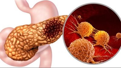  علماء يقومون بتجربة لقاح لحماية الناس من الإصابة بسرطان البنكرياس