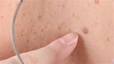 احذر.. رسومات تكشف تغييرات في الجلد يجب الانتباه إليها