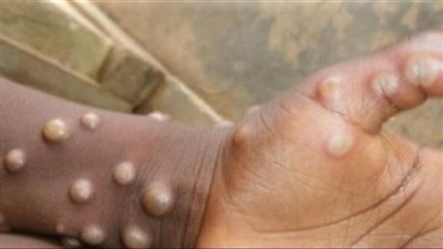  السلطات الأردنية تستحدث غرفتي عزل في مستشفى البشير في حال تسجيل أي إصابة بجدري القردة