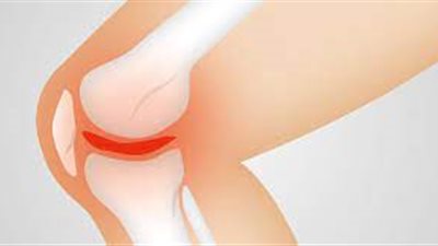 أهمية ممارسة الرياضة بالنسبة لمرضى الفُصال العظمي