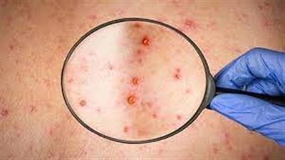 وزارة الصحة الألمانية تعلن رصد 4 حالات مصابة بمرض جدري القردة حتى الآن في البلاد