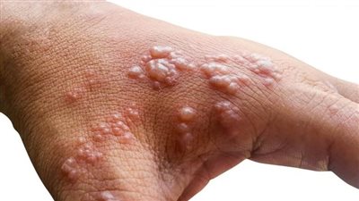 وسط قلق عالمي.. المملكة المتحدة تنشر صورا حديثة لآثار فيروس جدري القرود على الجلد