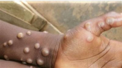 مجموعة من النصائح للوقاية من فيروس جدري القرود