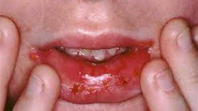  فطريات الفم قد ترجع إلى أسباب عدة.. ما هي؟