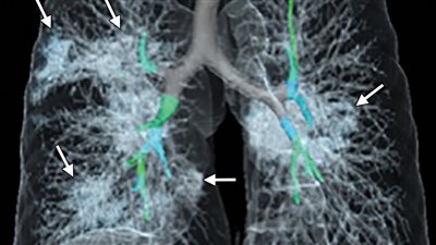  نوع خاص من التصوير بالرنين المغناطيسي يكشف ما يحدث بعد عام من عدوى كورونا