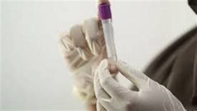  المستويات العالية من الكولسترول الجيد قد تقلل من خطر الإصابة بالزهايمر