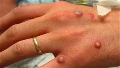  الصحة المغربية تحسم الجدل بشأن الحالات الثلاث المشتبه في إصابتها بفيروس جدري القرود