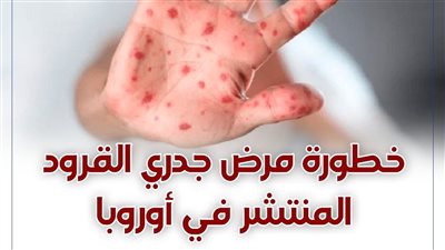 خطورة مرض جدري القرود ومدى انتشاره 