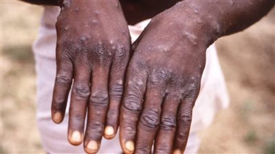 ابتكار ثلاثة أنواع من الاختبارات للكشف فيروس جدري القردة