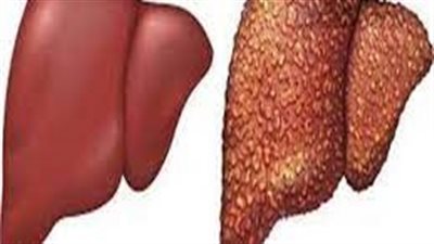  العوامل التي تسبب في الإصابة بالتليف الكبدي