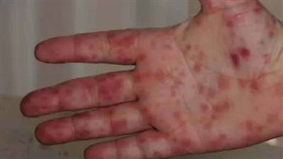 إنفلونزا الطماطم.. وباء جديد ينافس جدري القرود على السيطرة 