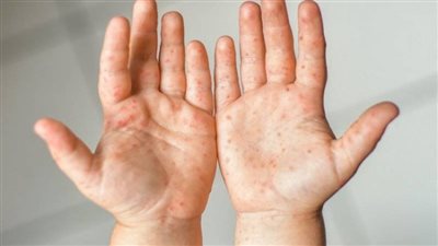 السلطات الماليزية تغلق 180 روضة أطفال بسبب انتشار مرض الطفح الجلدي 