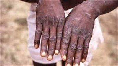  السلطات الصحية المكسيكية تؤكد رصد أول إصابة بجدري القردة في البلاد