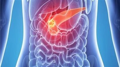 دراسة تكشف عن العلاقة بين حصى المرارة وسرطان البنكرياس