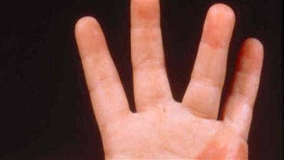 طبيب روسي يكشف أن رعشة اليدين قد تشير إلى مرض خطير