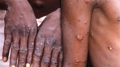 السلطات الصحية في الكونغو: 9 أشخاص لقوا حتفهم متأثرين بإصابتهم بمرض جدري القرود 
