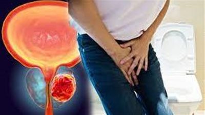 خطر الإصابة بسرطان البروستات متعلق بنقص هذا الفيتامين