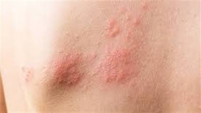 فروق لا تعرفها حول جدري الماء العادي وجدري القردة