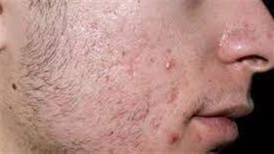 كيف تواجه مشكلة حب الشباب المتأخر؟