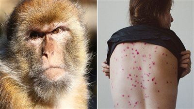 أخصائي فيروسات روسي: احتمال ظهور طفرة خطيرة لجدري القردة ضعيف جدًا