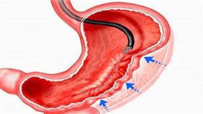 كيفية تقليل مخاطر الإصابة بالسرطان