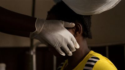 شيكاغو تكتشف أول حالة يشتبه بإصابتها بجدري القردة