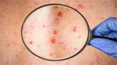 الحكومة الفنزويلية تعلن تسجيل أول إصابة بجدري القرود لرجل دخل البلاد