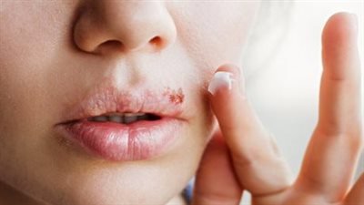 هل يوجد علاج لمرض هربس الفموي؟