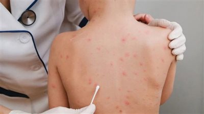 الصحة العالمية تُبشر بتغيير مسمى 