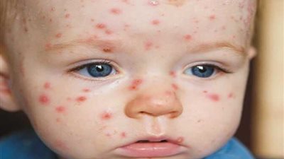 بريطانيا: ارتفاع إصابات جدرى القرود لـ574 حالة