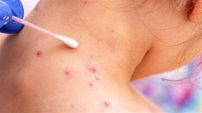 منظمة الصحة العالمية تستنفر العالم بسبب جدري القرود