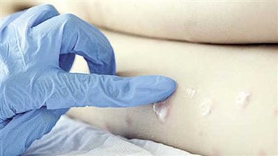 أول حالتين مشتبه في إصابتهما بجدرى القردة بكوريا الجنوبية