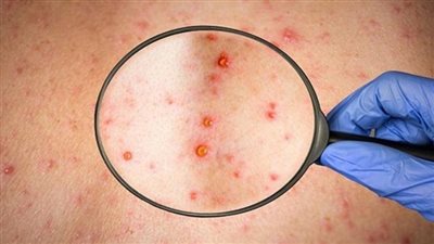 تركيا تشهد أول حالة إصابة بجدري القرود