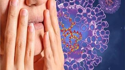 أحدث البيانات تكشف طبيعة جدري القردة في الولايات المتحدة