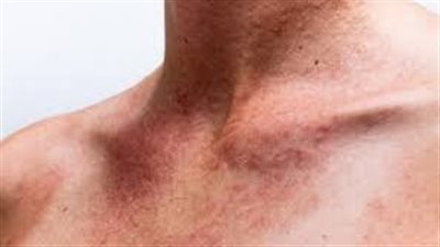 كل ما تريد معرفته حول التسمم الشمسي.. الأسباب وطرق العلاج