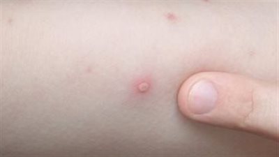 الكشف الحمض النووي لفيروس القردة الذي ينتشر حاليا في العالم